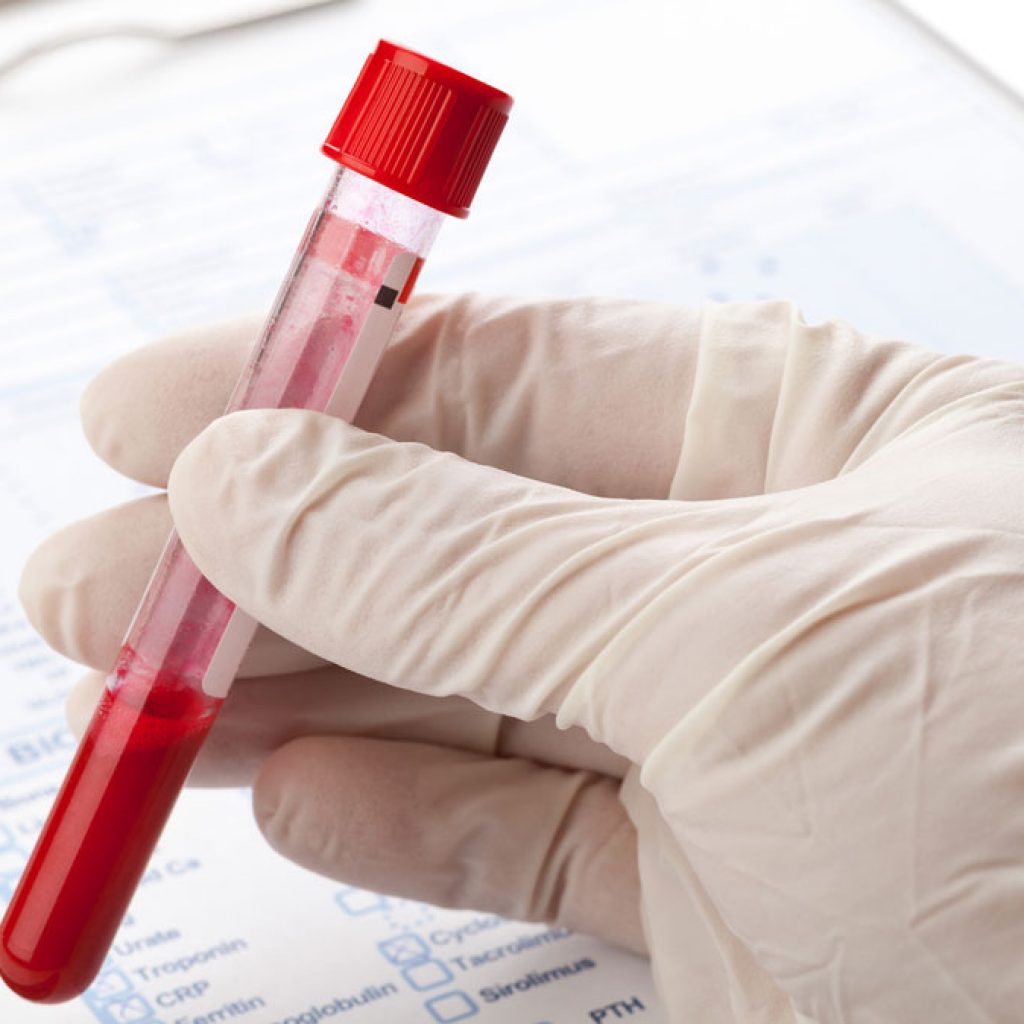 Как сдавать анализ крови на гормоны надпочечников thumbnail