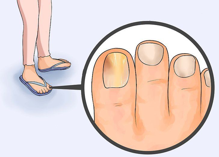 Причины почернения пальцев на ногах