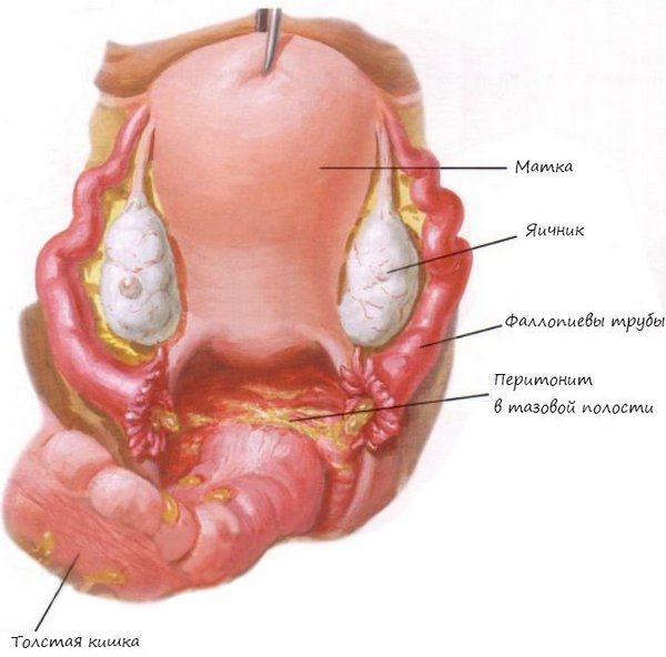 Пластический пельвиоперитонит в гинекологии при менопаузе thumbnail