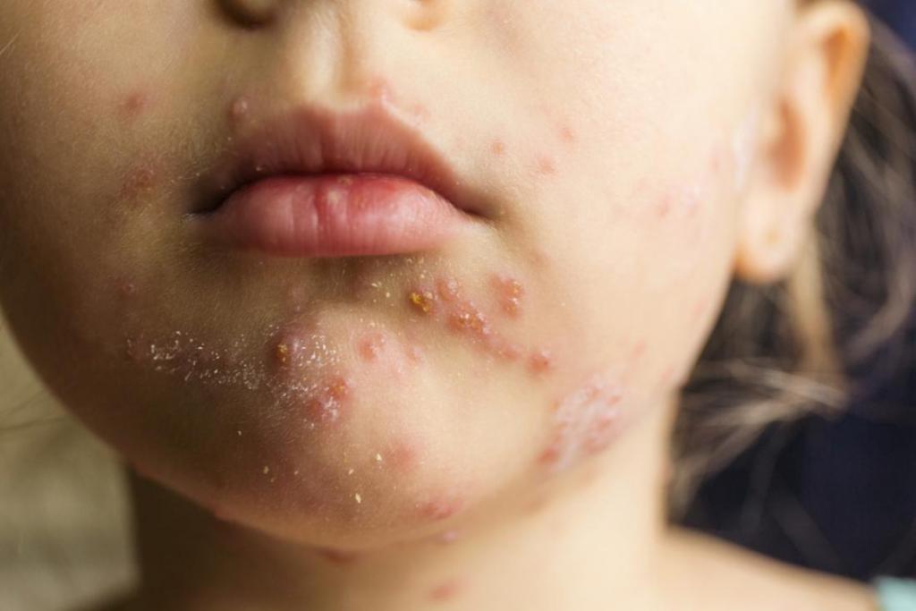 Аллергия на коже от крема у ребенка thumbnail