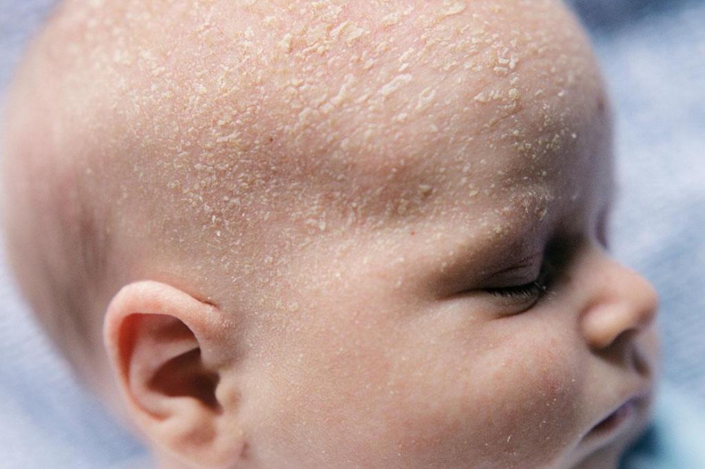 Крема от сыпи и аллергии для ребенка thumbnail