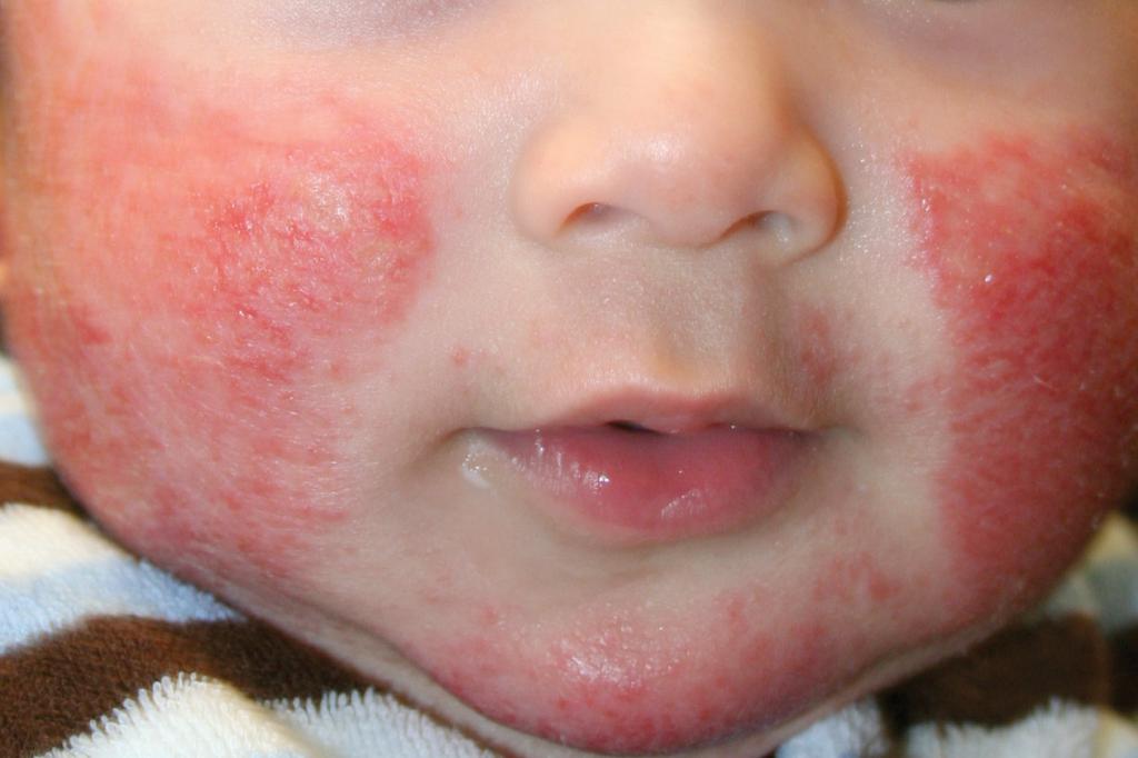Детский крем с ромашкой при аллергии thumbnail
