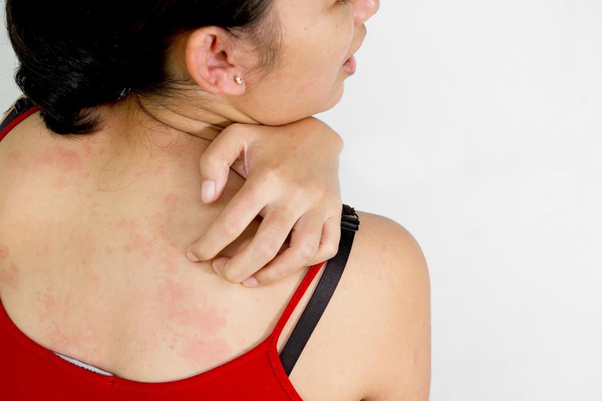 почему чешется спина при аллергии
