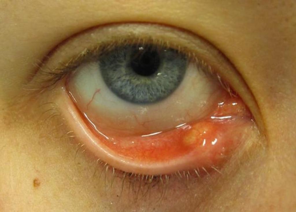 папилломы на слизистой глаз