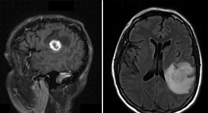 Выявление патологий мозга при МРТ