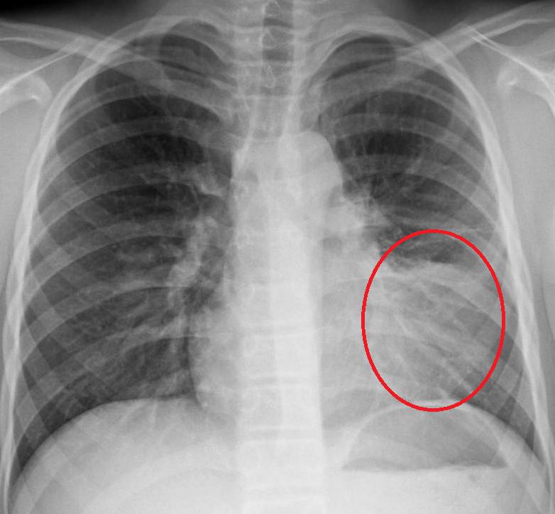 Воспаление легких на рентгене