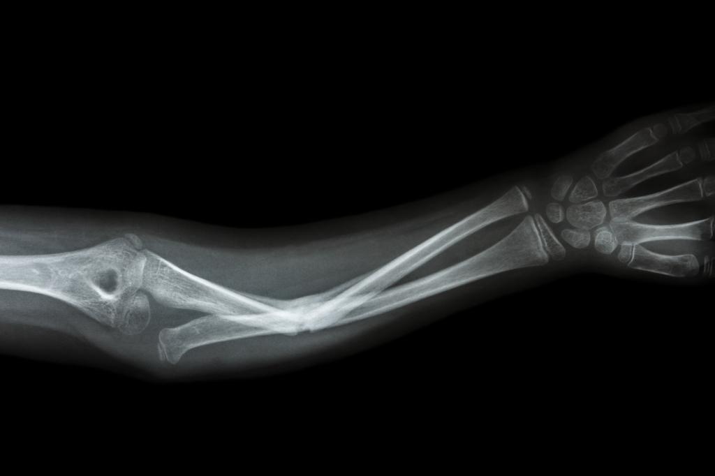 При переломе неправильно срастается лучевая кость thumbnail