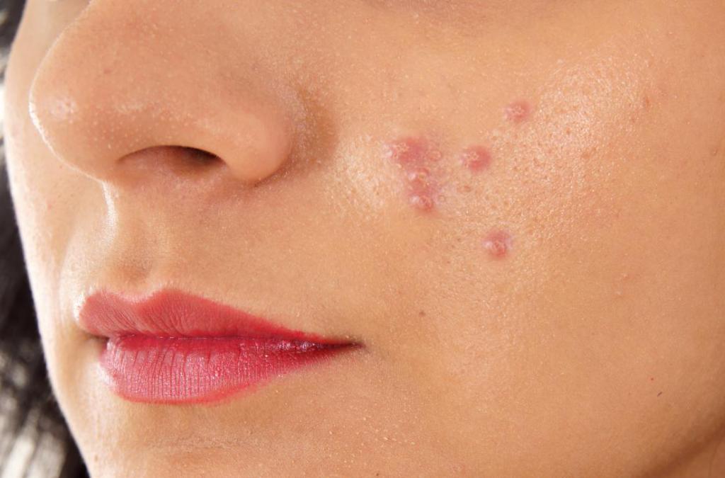 Аллергия гнойное на лице и шее thumbnail