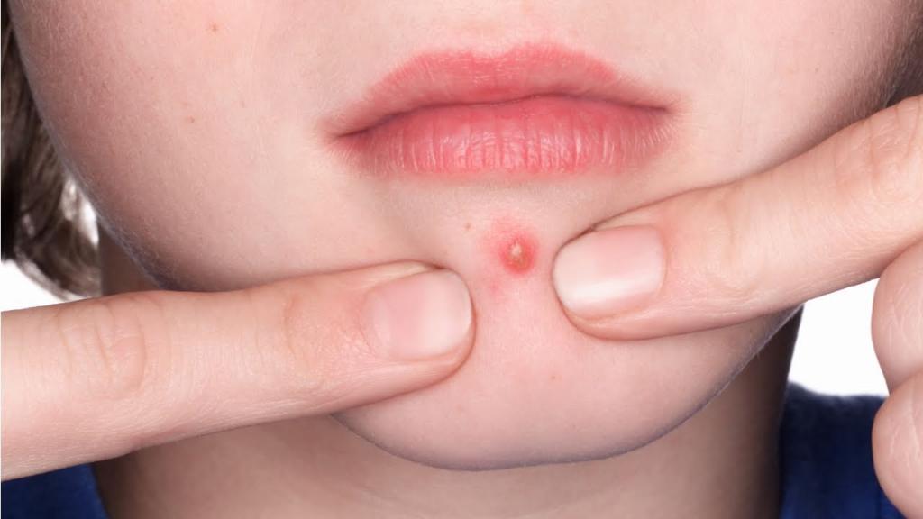 Аллергия на лице как прыщи фото thumbnail
