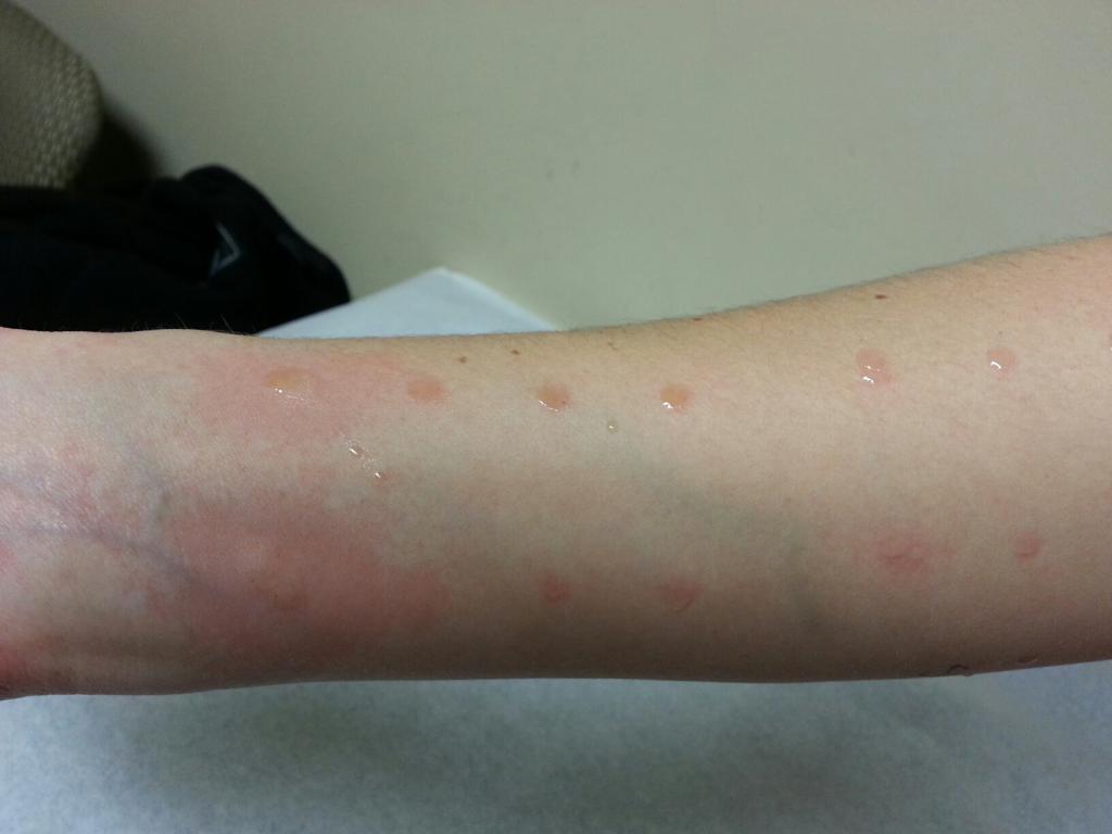 Подкожные прыщи на лице аллергия thumbnail