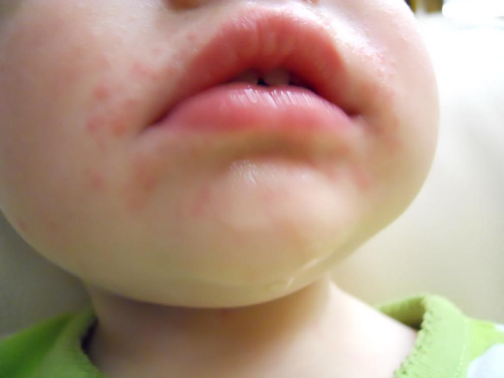 Пищевая аллергия прыщи на лице thumbnail