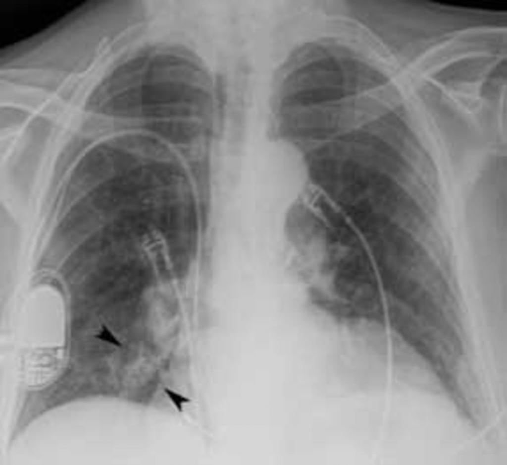 Как выглядит снимок рентгена с пневмонии thumbnail