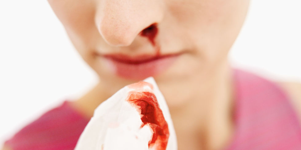 Частые кровотечения из носа