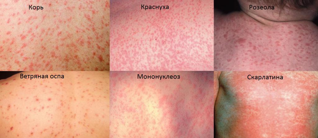 Красные пятна при различных инфекционных заболеваниях