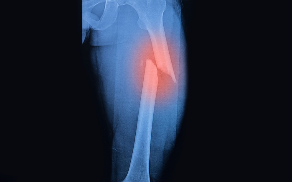 Процесс зарастания костей скелета взрослого человека при переломах thumbnail