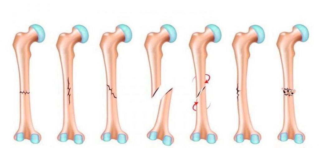 Рост кости в толщину и срастание костей при переломе обеспечивает thumbnail