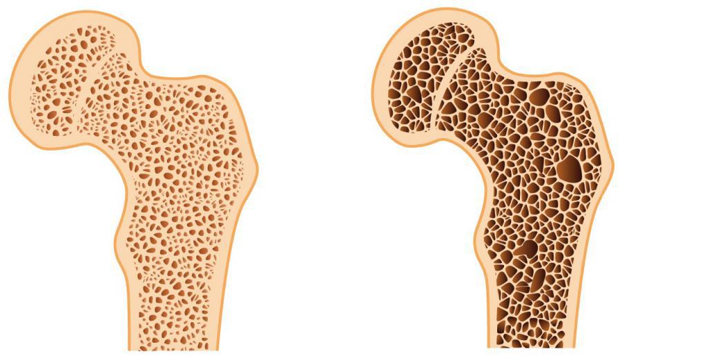 Кости здоровая и с остеопорозом