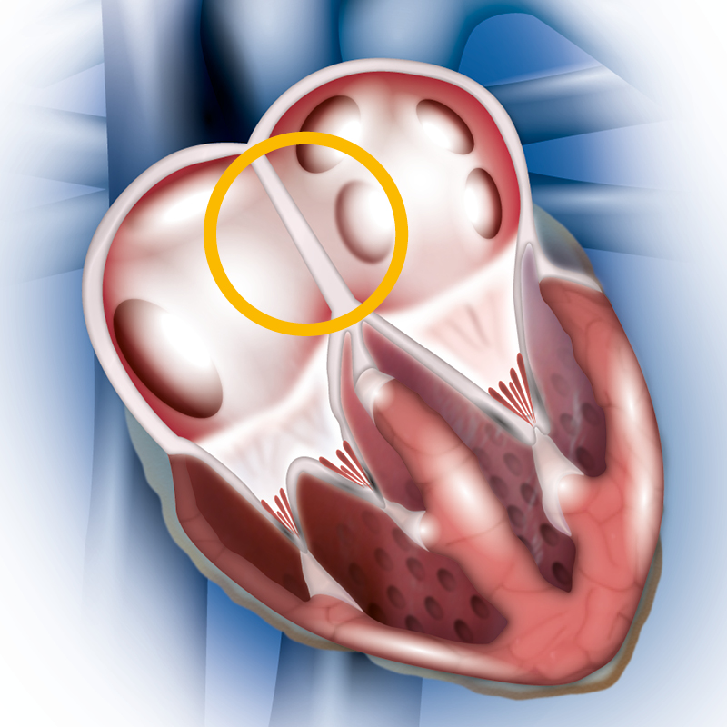 окклюдер операция на сердце