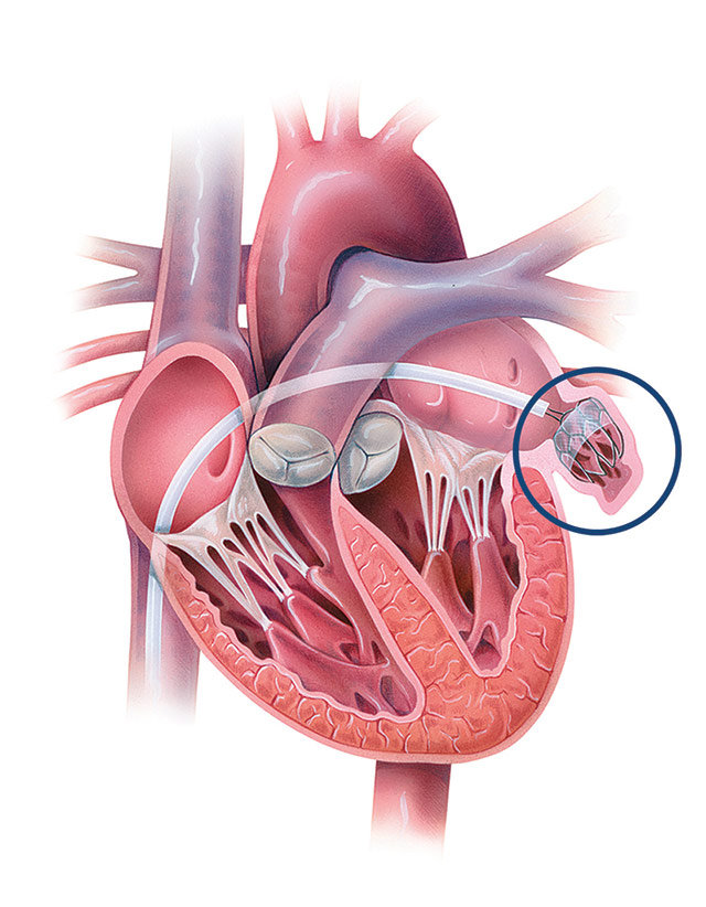 окклюдер на сердце после операции