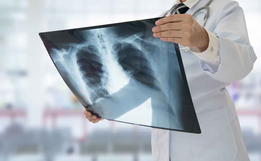 пневмония на рентгеновских снимках