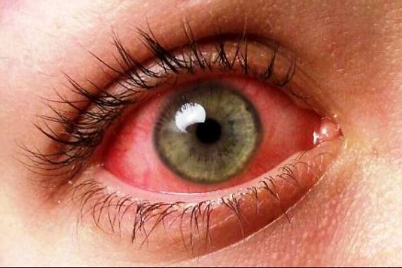 Глаза человека заболевание роговицы глаза thumbnail