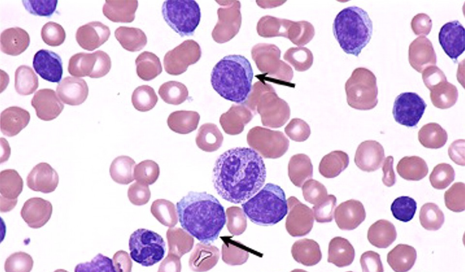 Клетки боткина гумпрехта в анализе крови thumbnail