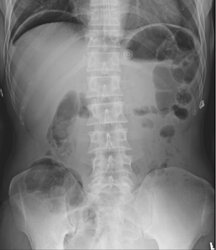 Рентген брюшной полости противопоказания thumbnail