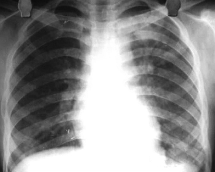 Затемнения на легких туберкулез или пневмония thumbnail