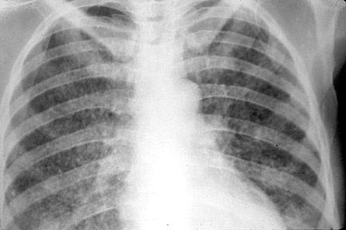Пневмония и туберкулез похожи на снимке thumbnail