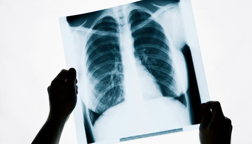 Пневмония и туберкулез снимок фото thumbnail