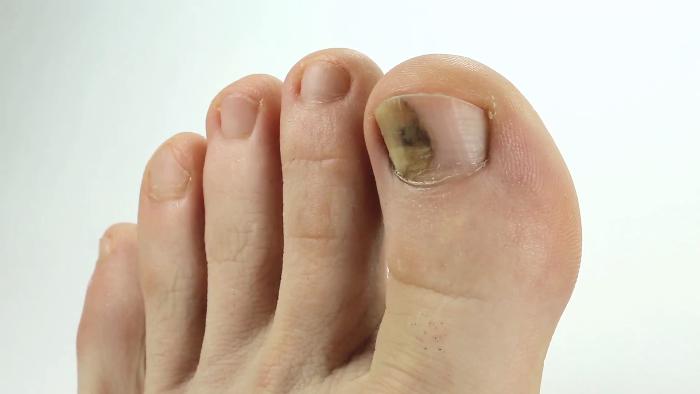 Повреждение ногтя на ноге при ушибе thumbnail