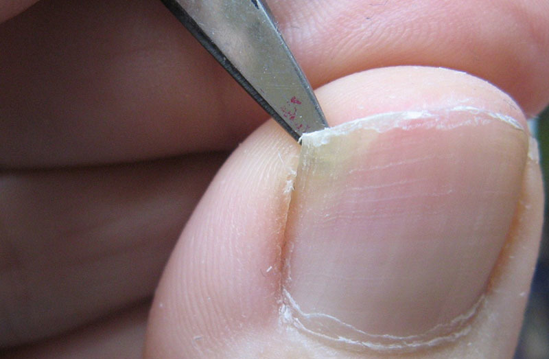 Ушиб ногтя на ноге синий палец thumbnail