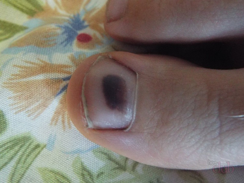 Что делать если ушиб палец на ноге ногтя thumbnail