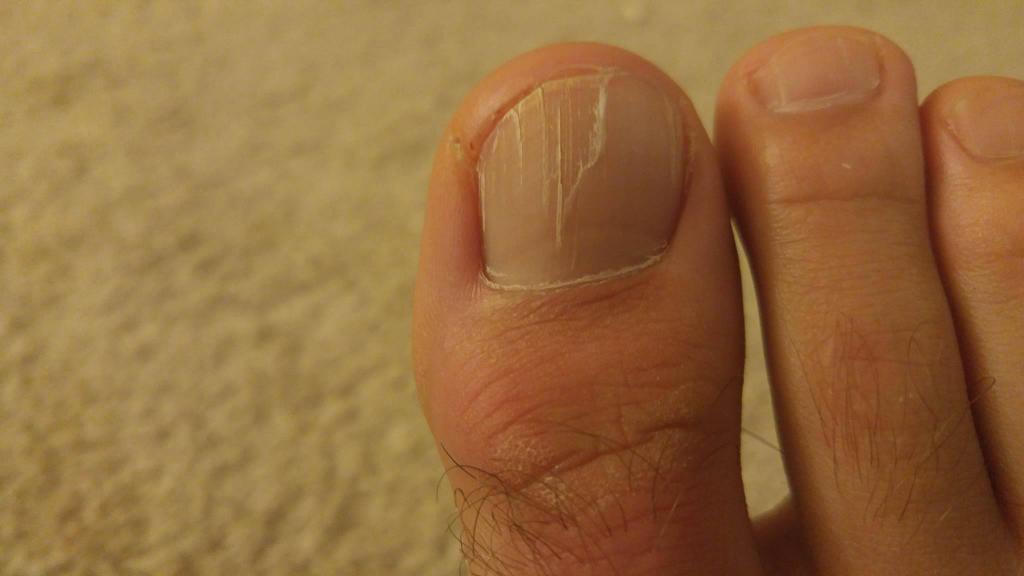 Трескаются ногти на ногах лечение thumbnail