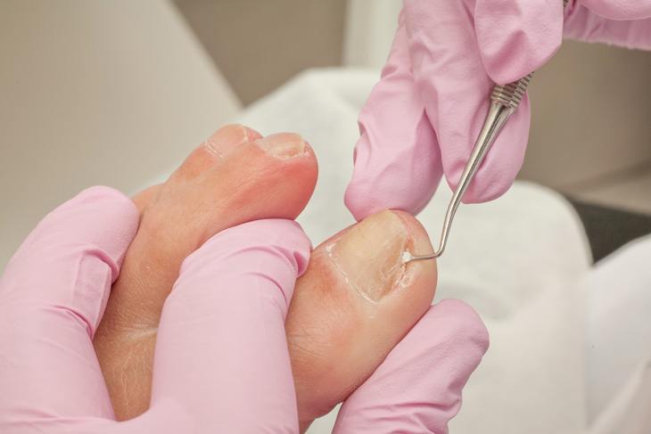 Трескаются ногти на ногах причины и лечение thumbnail