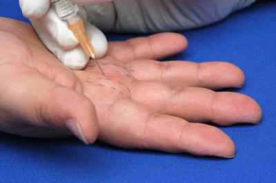 стенозирующий лигаментит щелкающий палец