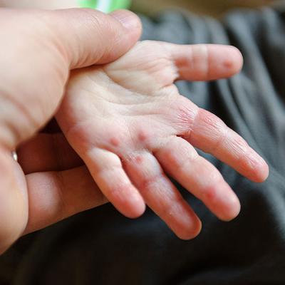 Аллергия на пальцах рук у ребенка
