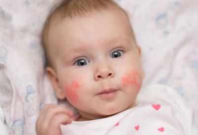 Мазь при аллергии у ребенка 1 года thumbnail