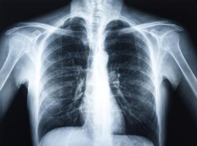 Рентген грудины и ребер