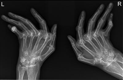 рентген при ревматоидном артрите
