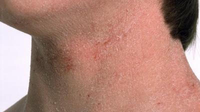 Таблетки от атопического дерматита на коже thumbnail
