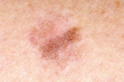 диагностика предраковых заболеваний кожи