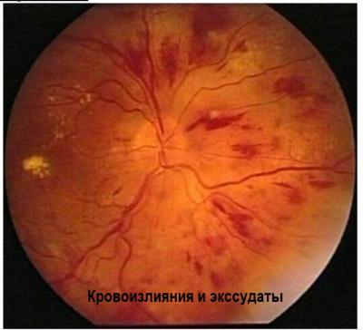 Глазное дно при гипертонической болезни - кровоизлияния и экссудаты