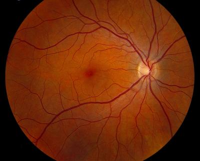 Глазное дно при гипертонической болезни - глазное дно у здорового человека