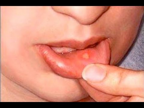 Сыпь и язвы на внутренней губе