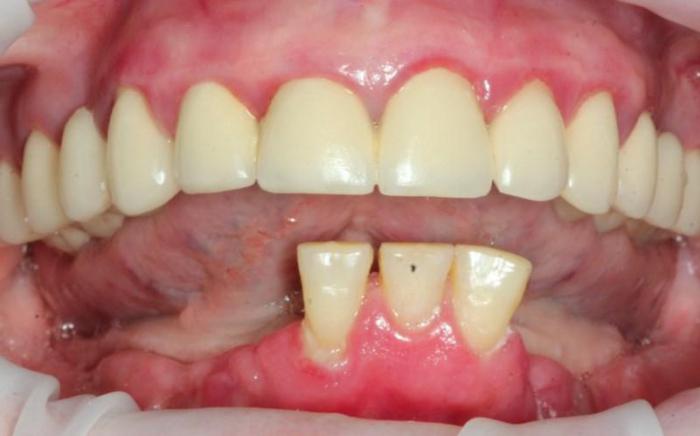 Состояние зубов до имплантации