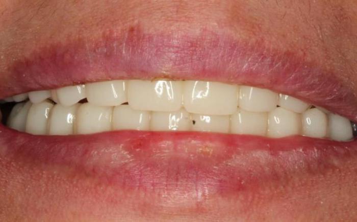 После имплантации с немедленной нагрузкой зубным протезом