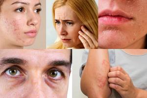 Повреждается коллаген и эластин: какие кожные заболевания являются последствиями стресса