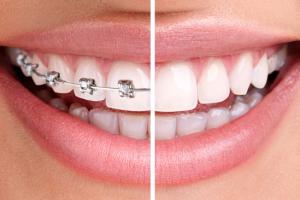 Необходимость или дань моде: стоматолог о повальном увлечении брекетами