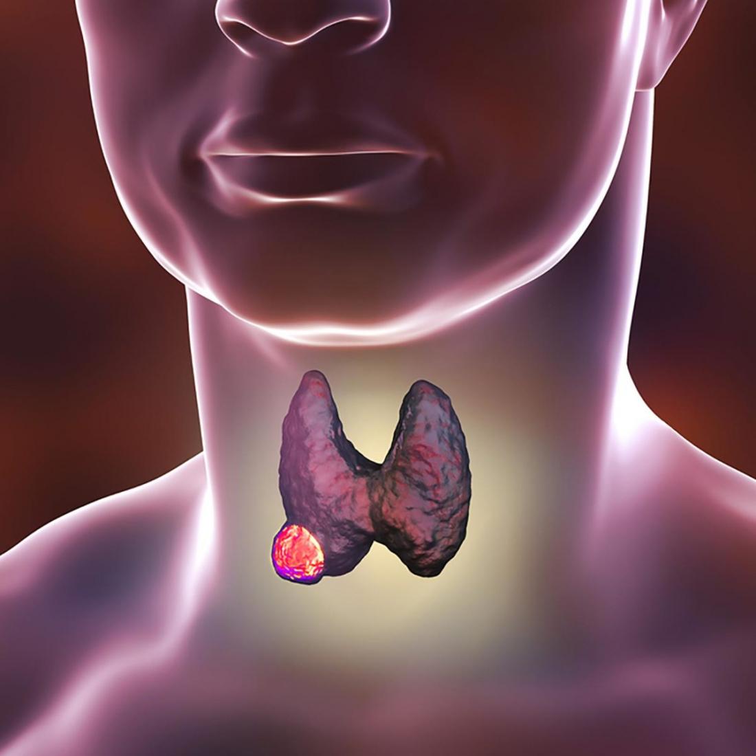 Щитовидная железа и желчный пузырь. Тумор щитовидной железы. Раковая опухоль щитовидной железы. Опухоли щетовиднойжелезы. Злокачественные заболевания щитовидной железы.